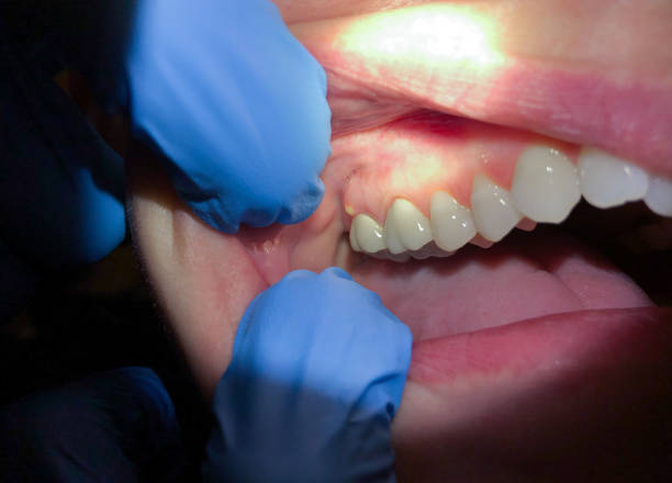 Best Emergency Denture Repair in Calais, ME